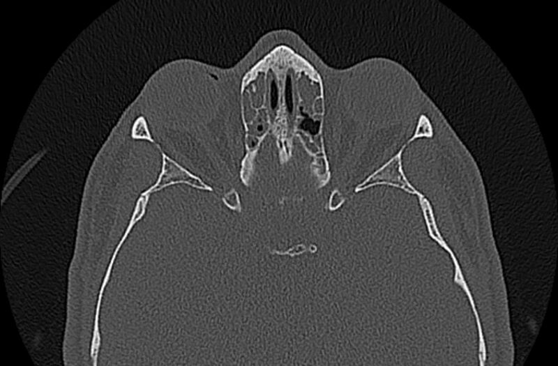 File:Chronic rhinosinusitis (Radiopaedia 65079-74075 Axial bone window 59).jpg
