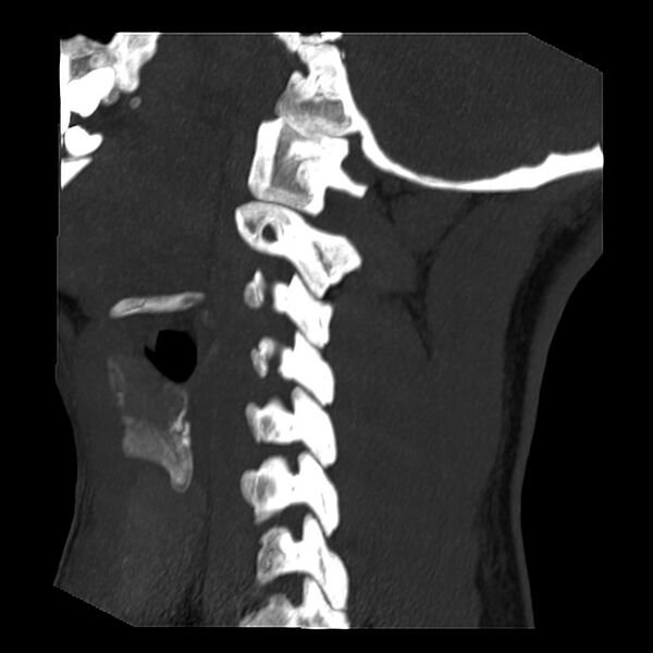 File:Clay-shoveler fracture (Radiopaedia 22568-22590 Sagittal MIP 4).jpg