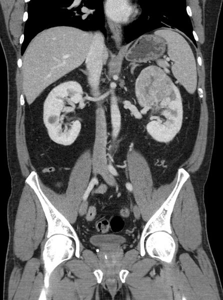 File:Clear cell renal cell carcinoma (Radiopaedia 61449-69393 F 22).jpg