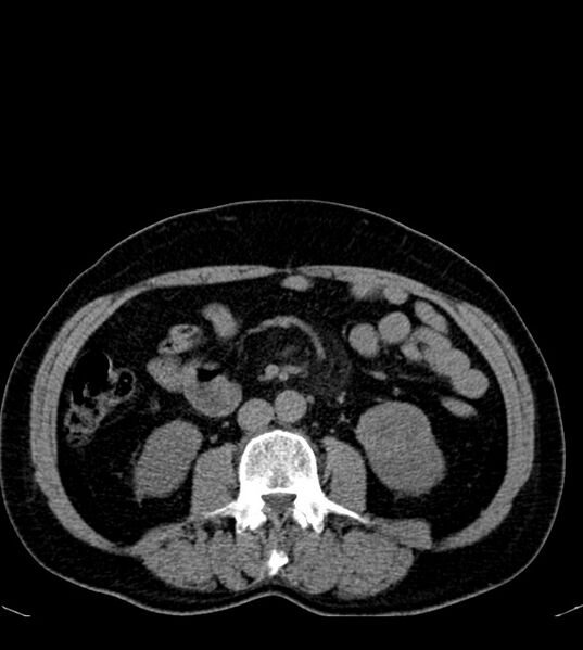 File:Clear cell renal cell carcinoma (Radiopaedia 85006-100539 Axial non-contrast 46).jpg