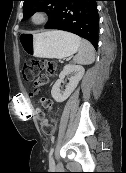 File:Closed loop obstruction - internal hernia into nephrectomy bed (Radiopaedia 59867-67320 C 21).jpg