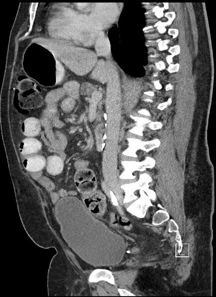 File:Closed loop obstruction - internal hernia into nephrectomy bed (Radiopaedia 59867-67320 C 52).jpg