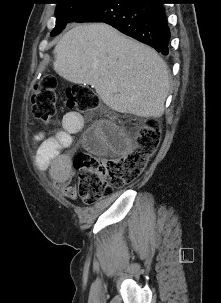 File:Closed loop obstruction - internal hernia into nephrectomy bed (Radiopaedia 59867-67320 C 87).jpg