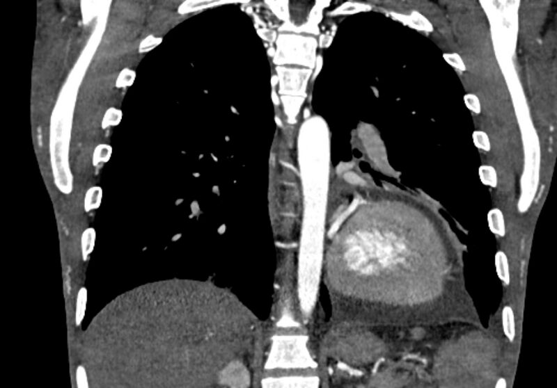 File:Coarctation of aorta with aortic valve stenosis (Radiopaedia 70463-80574 C 164).jpg