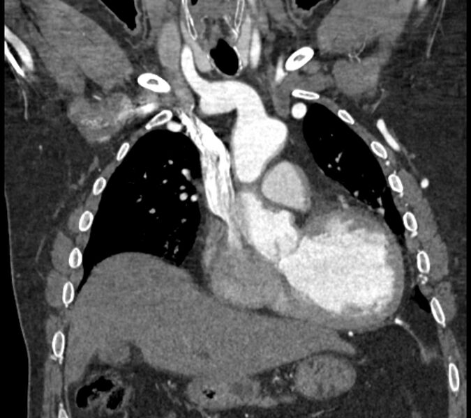File:Coarctation of the aorta (Radiopaedia 53752-59822 B 30).jpg
