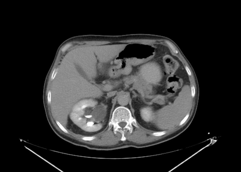 File:Colon cancer mimicking renal cell carcinoma (Radiopaedia 28986-29335 Axial C+ delayed 20).jpg