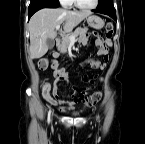 File:Colon carcinoma with hepatic metastases (Radiopaedia 29477-29961 B 16).jpg