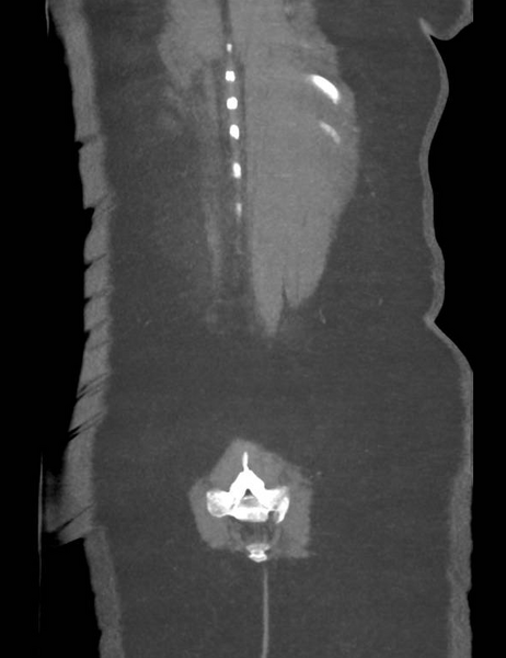 File:Colonic pseudo-obstruction (Radiopaedia 79752-92980 B 54).png
