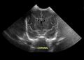 Connatal cyst (Radiopaedia 63825).jpg