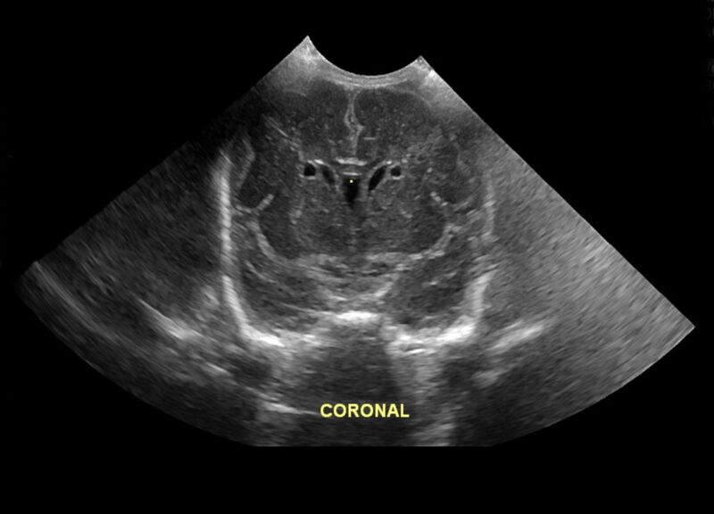 File:Connatal cyst (Radiopaedia 63825).jpg