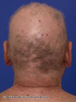 Diffuse alopecia due to severe alopecia areata