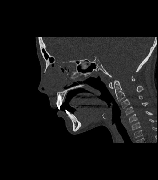 File:Nasoorbitoethmoid fracture (Radiopaedia 90044-107205 Sagittal bone window 73).jpg