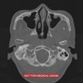 Nasopharyngeal carcinoma recurrence - skull base destruction (Radiopaedia 29107-29490 Axial bone window 93).jpg