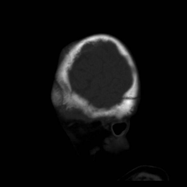 File:Neuroblastoma with skull metastases (Radiopaedia 30326-30958 Sagittal bone window 4).jpg