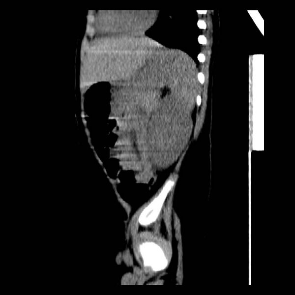 File:Neuroblastoma with skull metastases (Radiopaedia 30326-30960 B 33).jpg