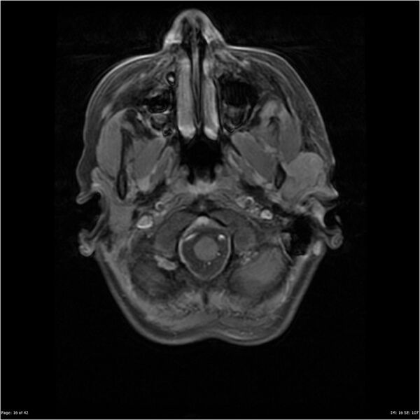 File:Neurofibromatosis type 1 (Radiopaedia 22541-22564 Axial T1 C+ fat sat 16).jpg