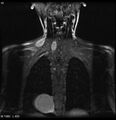 Neurofibromatosis type 2 - cranial and spinal involvement (Radiopaedia 5351-7112 E 2).jpg