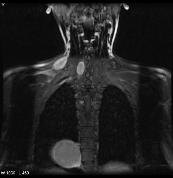 File:Neurofibromatosis type 2 - cranial and spinal involvement (Radiopaedia 5351-7112 E 2).jpg