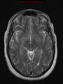 Neuroglial cyst (Radiopaedia 10713-11184 Axial T2 13).jpg