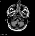 Neurosarcoidosis (Radiopaedia 10930-17204 Axial FLAIR 2).jpg