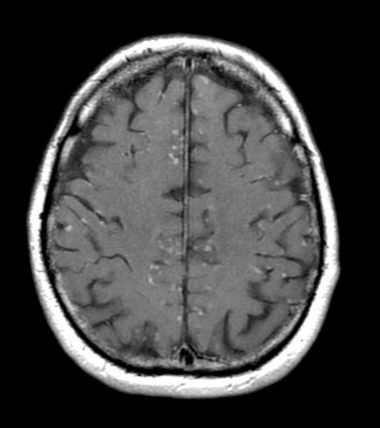 File:Neurosarcoidosis (Radiopaedia 11674-12037 Axial 4).jpg