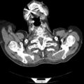 Non Hodgkin lymphoma in a patient with ankylosing spondylitis (Radiopaedia 84323-99624 B 2).jpg