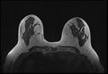 Normal breast MRI - dense breasts (Radiopaedia 80454-93850 Axial T1 111).jpg