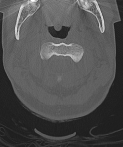 File:Normal cervical spine MRI (including Dixon) (Radiopaedia 42762-45926 Axial bone window 15).png