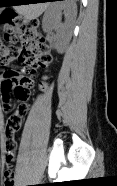 File:Normal lumbar spine CT (Radiopaedia 46533-50986 C 89).png