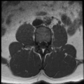 Normal lumbar spine MRI (Radiopaedia 35543-37039 Axial T1 25).png