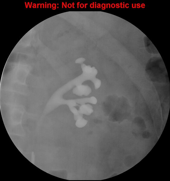 File:Normal retrograde pyelography of a native and transplant kidney (Radiopaedia 40480-43054 Native kidney 6).jpg