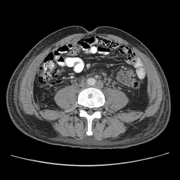 File:Obstructive bladder transitional cell carcinoma (Radiopaedia 9825-10410 A 16).jpg