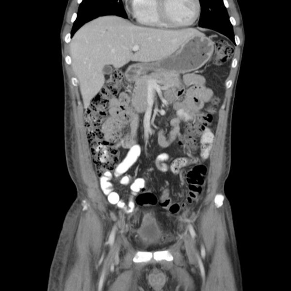 File:Obstructive bladder transitional cell carcinoma (Radiopaedia 9825-10410 B 4).jpg