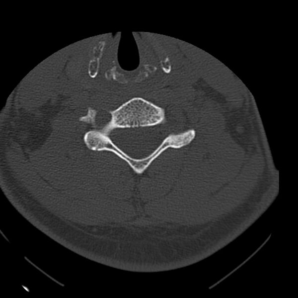 File:Occipital condyle fracture (Radiopaedia 31755-32691 Axial bone window 50).jpg