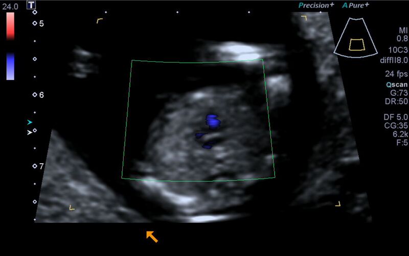 File:1st trimester nuchal-morphology ultrasound (Radiopaedia 44706-48477 Heart views cine with colour 128).jpg