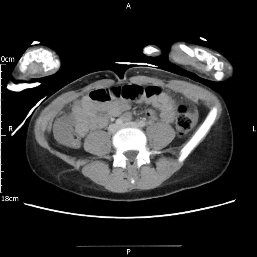 AAST grade IV kidney injury with CEUS follow-up (Radiopaedia 72353-82877 Axial C+ portal venous phase 46).jpg