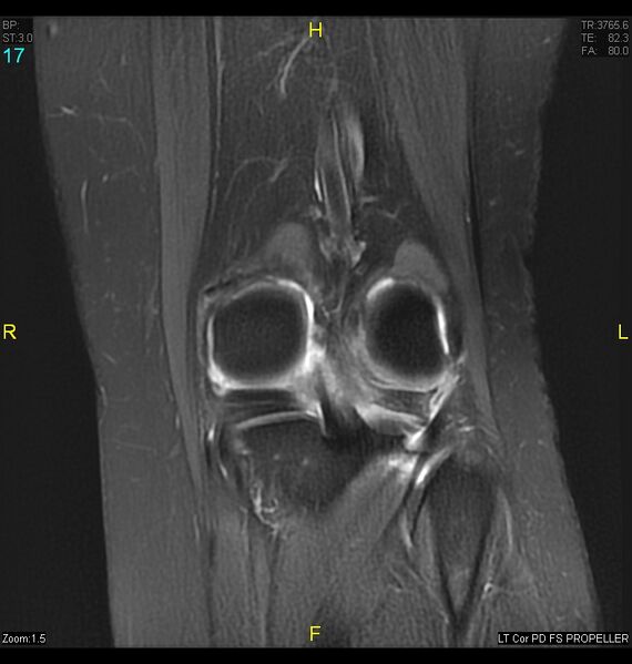 File:ACL mucoid degeration with cystic changes (Radiopaedia 48428-53341 Coronal PD fat sat 14).jpg