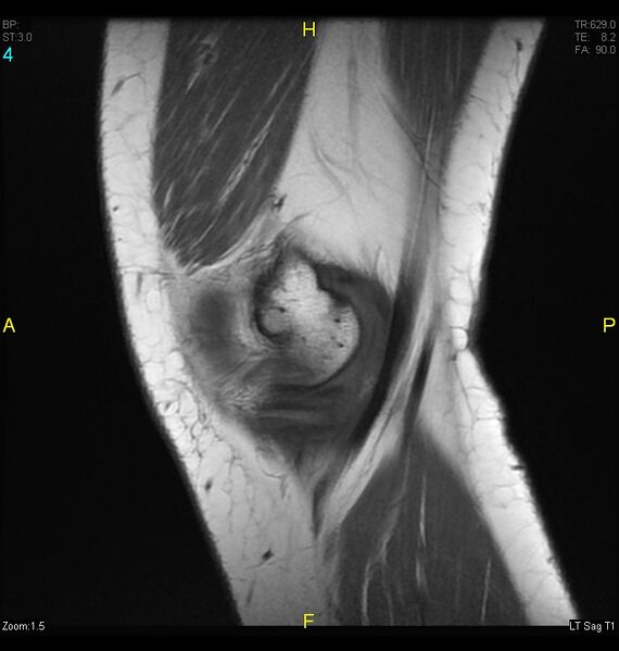 File:ACL mucoid degeration with cystic changes (Radiopaedia 48428-53341 Sagittal T1 2).jpg