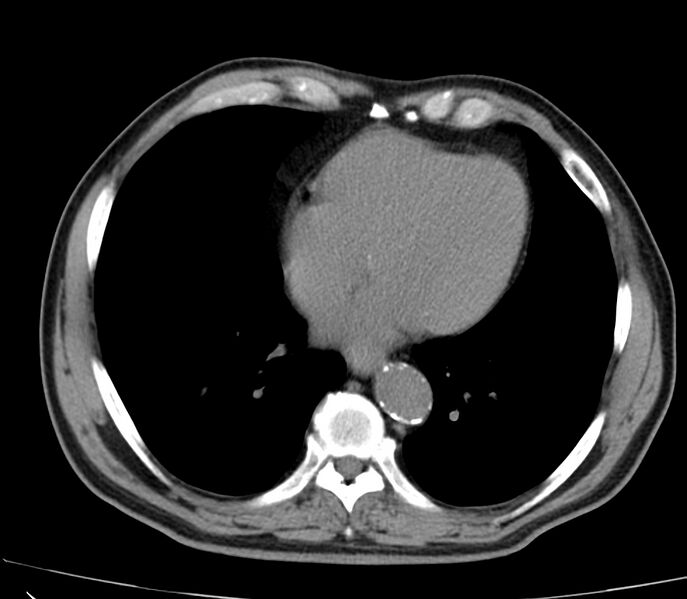 File:Abdominal aortic aneurysm (Radiopaedia 22421-22458 non-contrast 1).jpg