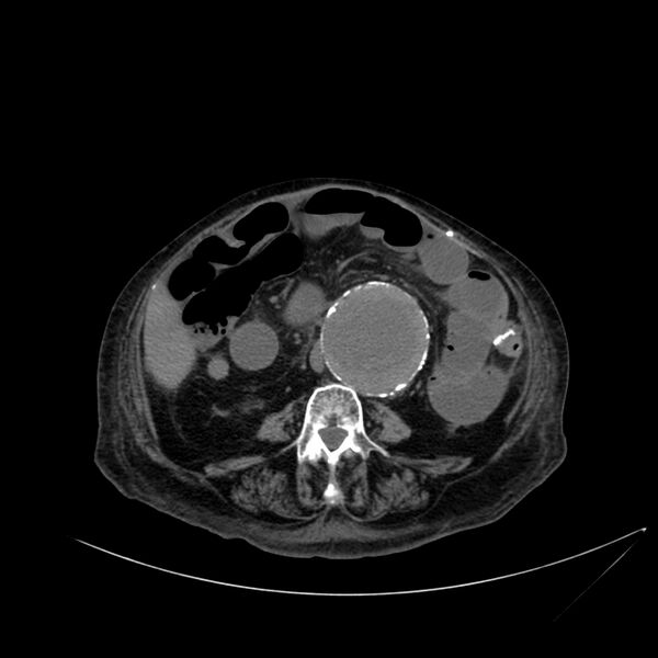 File:Abdominal aortic aneurysm - impending rupture (Radiopaedia 19233-19246 Axial non-contrast 72).jpg