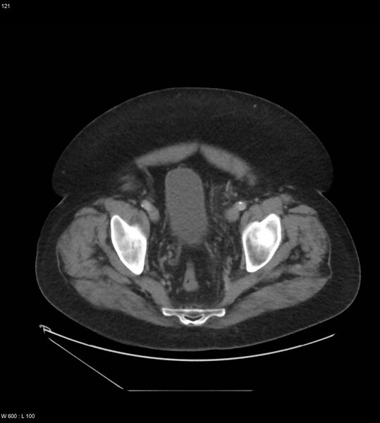 File:Abdominal aortic aneurysm with intramural hematoma then rupture (Radiopaedia 50278-55631 Axial C+ arterial phase 112).jpg