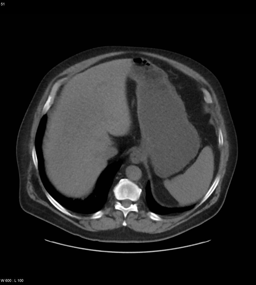 Abdominal aortic aneurysm with intramural hematoma then rupture (Radiopaedia 50278-55631 Axial non-contrast 47).jpg