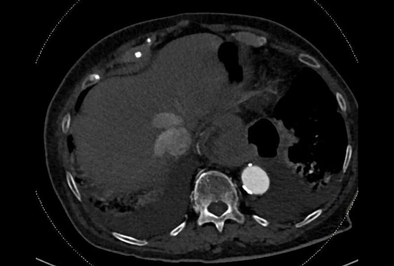 File:Abdominal aortic aneurysm with thrombus fissuration (Radiopaedia 73192-83919 Axial C+ arterial phase 4).jpg