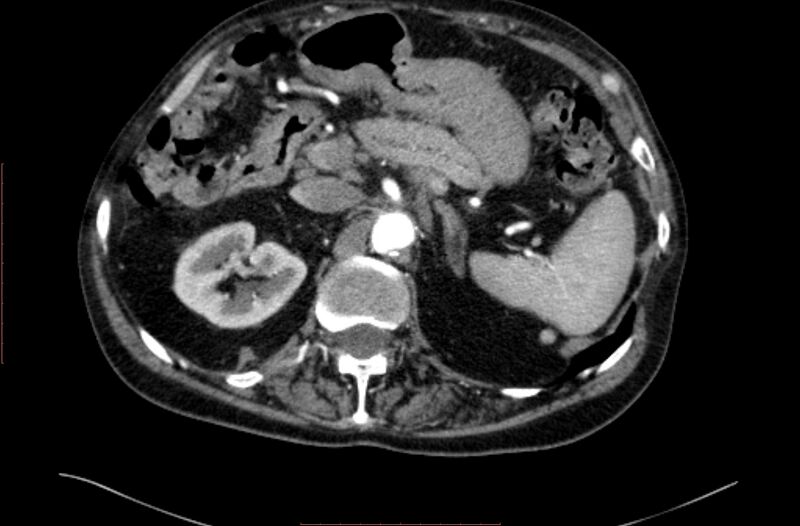 File:Abdominal aortic interposition tube graft and aneurysm thrombosis (Radiopaedia 71438-81857 Axial C+ arterial phase 26).jpg