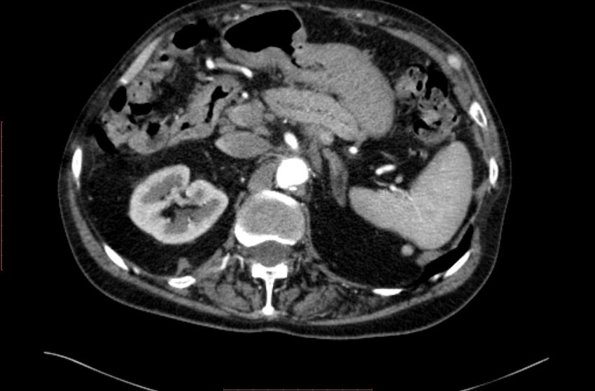 Abdominal aortic interposition tube graft and aneurysm thrombosis (Radiopaedia 71438-81857 Axial C+ arterial phase 26).jpg