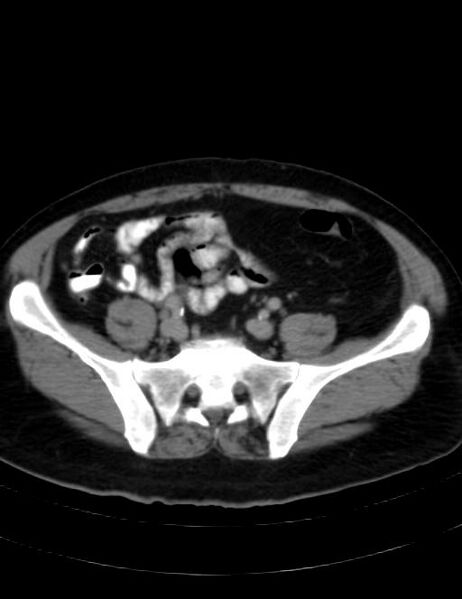 File:Abdominal lymphoma - with sandwich sign (Radiopaedia 53486-59492 Axial C+ portal venous phase 37).jpg