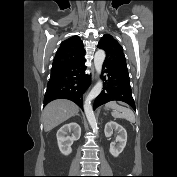 File:Aberrant right subclavian and left vertebral arteries (Radiopaedia 43467-46847 Coronal C+ portal venous phase 59).jpg