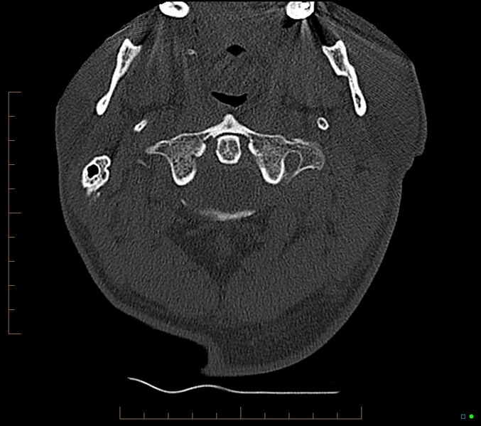 File:Accessory articulation of cervical transverse processes (Radiopaedia 82715-96933 Axial non-contrast 17).jpg