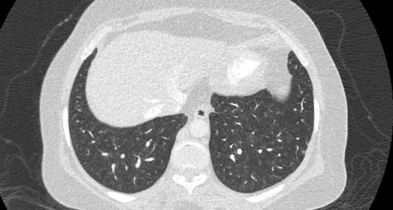 File:Accessory right inferior hepatic vein (Radiopaedia 65245-74259 Axial lung window 61).jpg