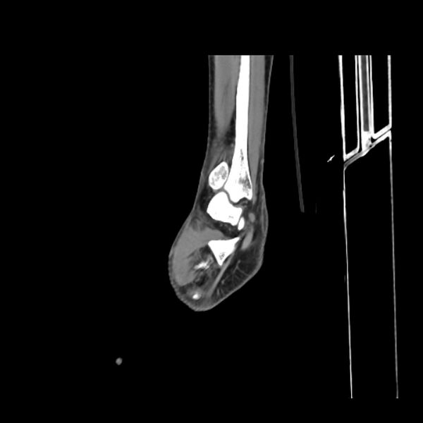 File:Accessory soleus muscle (Radiopaedia 61069-68943 Sagittal non-contrast 5).jpg
